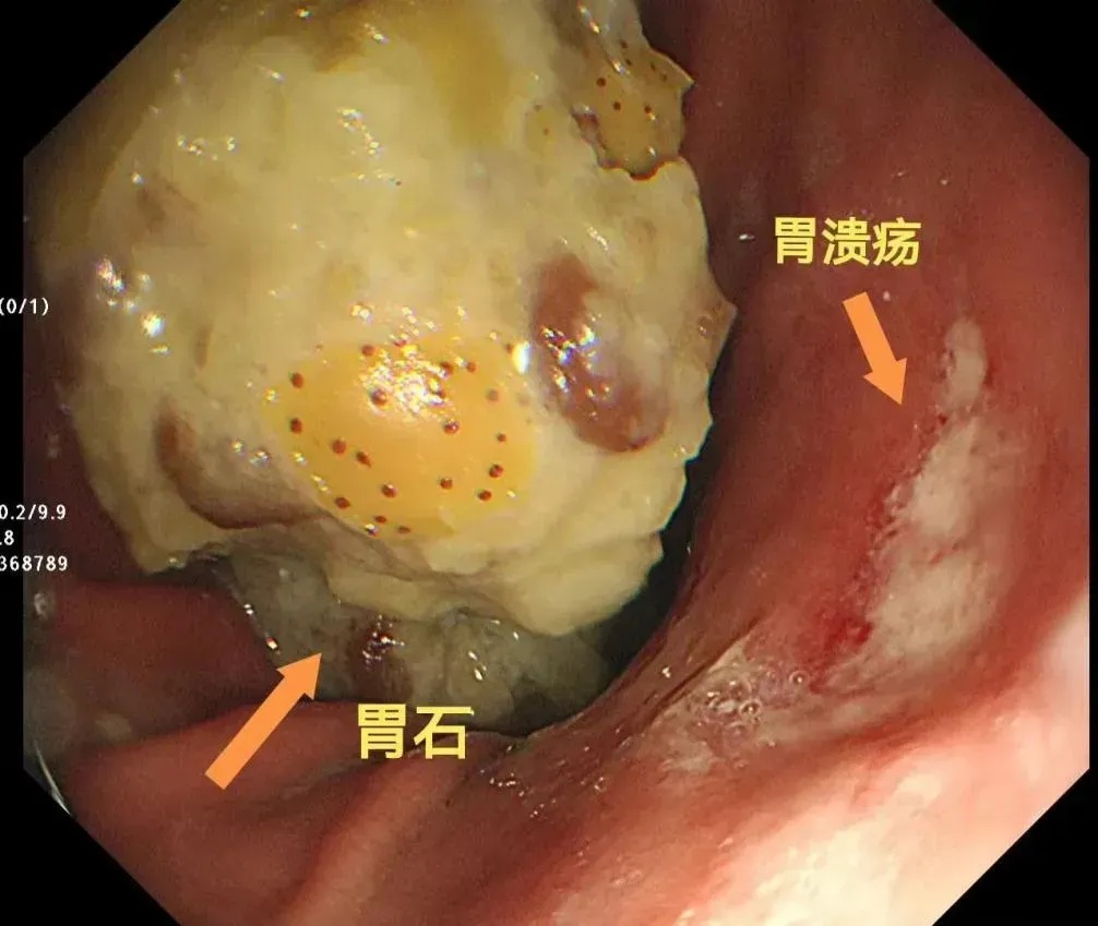 近期大量上市，有人食用后入院！紧急提醒→