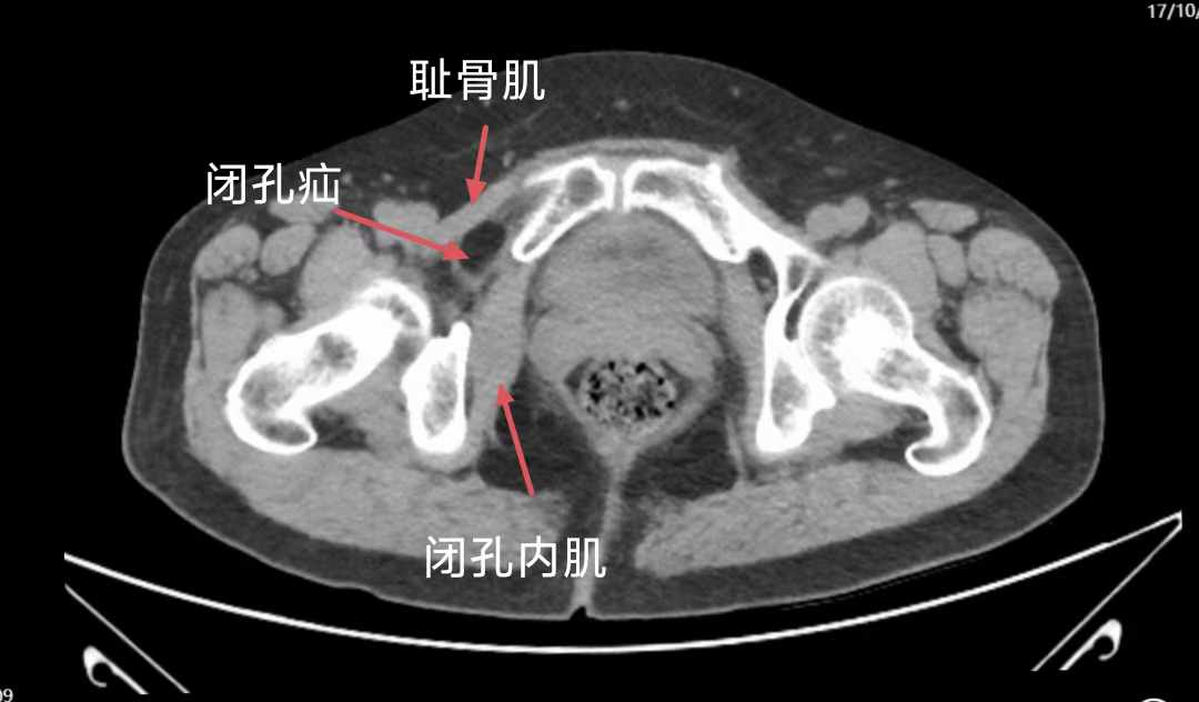 女子身体深藏“漏洞”,省二医东莞医院微创治愈,隔天便康复出院!_省二医医联体宣传联盟
