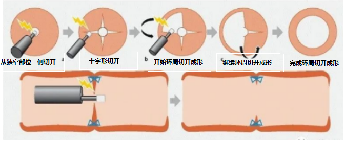 安阳地区医院消化内科成功实施内镜下狭窄放射状切开术_濮阳网