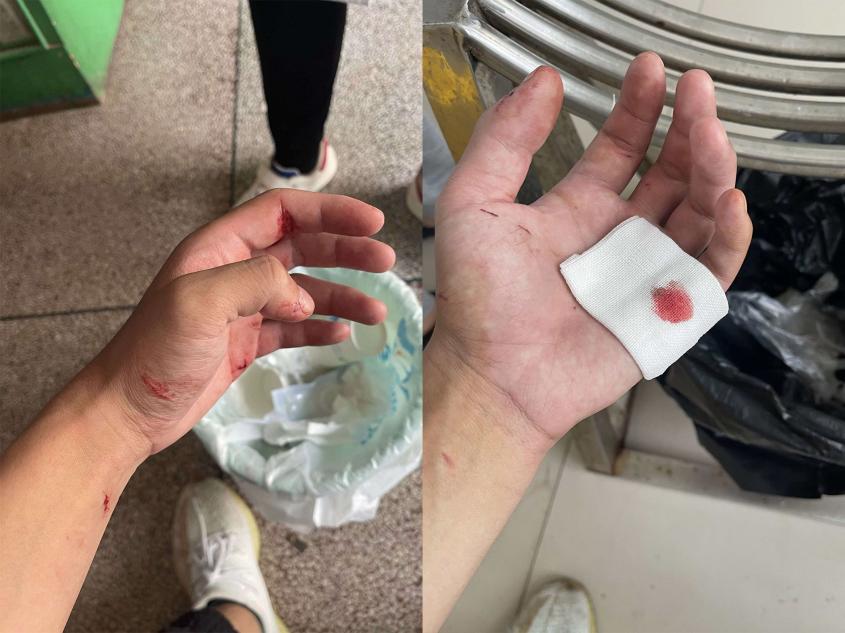 图为俊警官在一次抓捕后不慎受伤